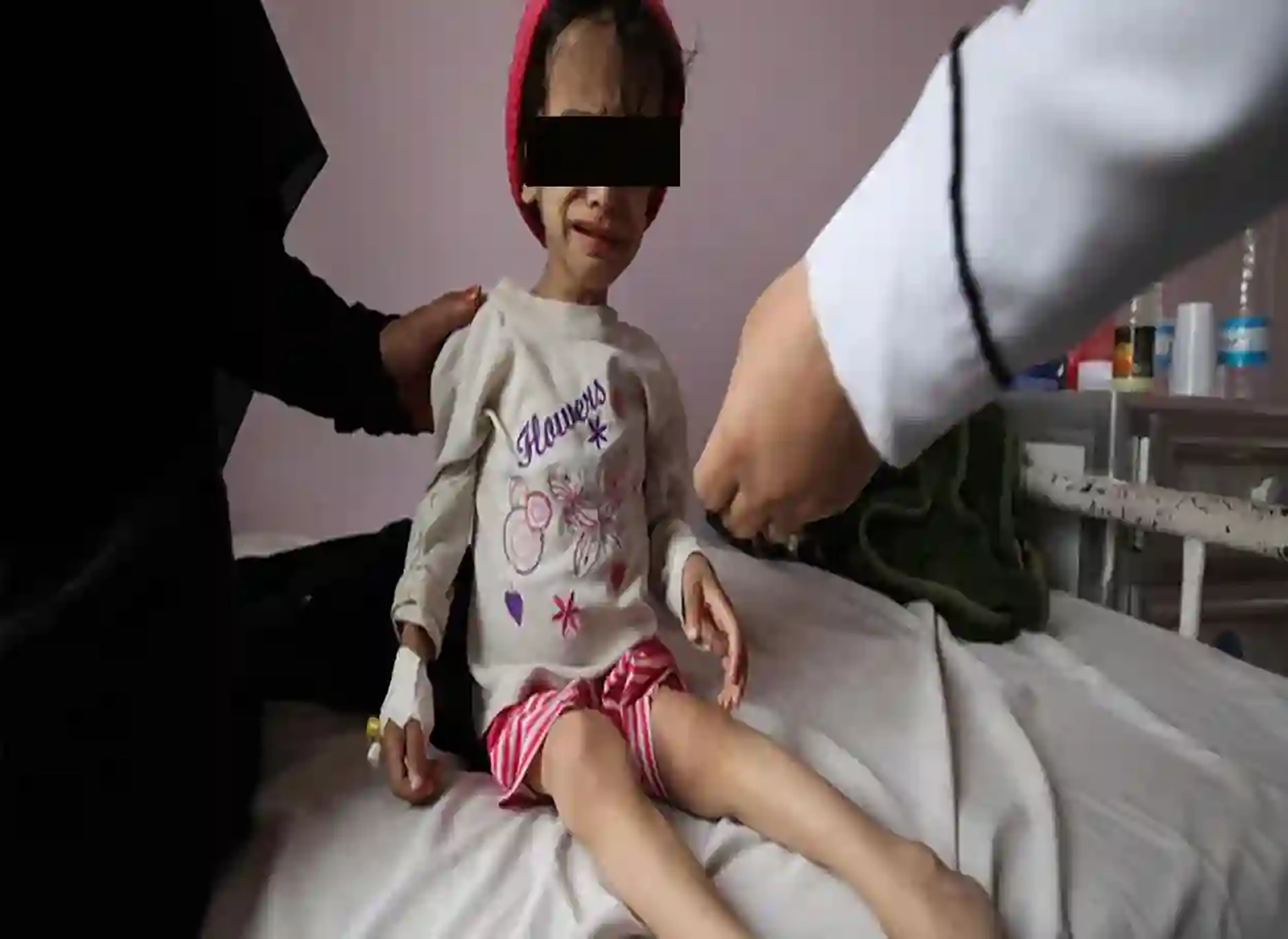 استقبال نحو 600 طفل مصاب بسوء التغذية الحاد في مستشفى بعمران خلال 4 أشهر